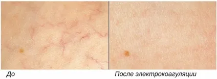 Електрокоагуляція судин на обличчі і ногах переваги, недоліки, альтернатива (електрокоагуляція судин на ногах) Електрокоагуляція судин на обличчі і ногах переваги, недоліки, альтернатива