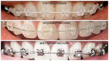 сапфірові брекети