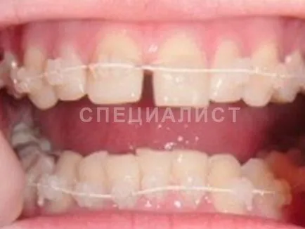 сапфірові брекети