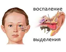 Симптоми вушного отиту перші ознаки, як виявляється, як розпізнати (симптоми) Симптоми вушного отиту перші ознаки, як виявляється, як розпізнати
