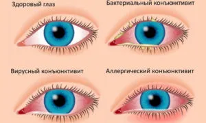 Симптоми кон'юнктивіту у дорослих ознаки, види, прічн, фото (причини виникнення кон'юнктивіту) Симптоми кон'юнктивіту у дорослих ознаки, види, прічн, фото