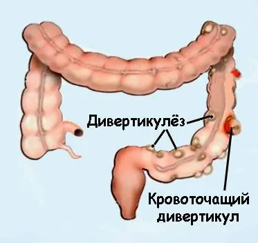 Сигмовиднакишка симптоми захворювань та їх лікування (симптоми) Сигмовиднакишка симптоми захворювань та їх лікування