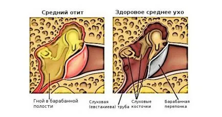 Симптоми вушного отиту перші ознаки, як виявляється, як розпізнати (вушного) Симптоми вушного отиту перші ознаки, як виявляється, як розпізнати