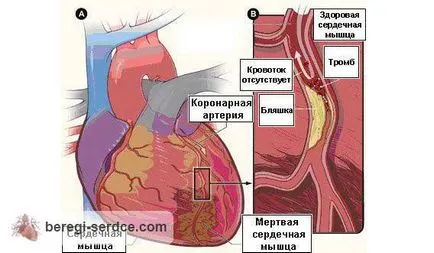 Синдром Морганьї - Адамса - Стокса невідкладна допомога, симптоми, лікування