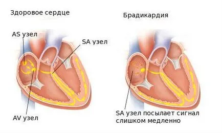 Синдром Морганьї-адамса-Стокса, невідкладна допомога при нападі