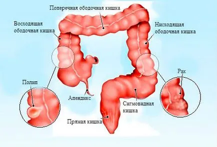 Сигмовиднакишка симптоми захворювань та їх лікування (пухлин сигмовидної кишки) Сигмовиднакишка симптоми захворювань та їх лікування