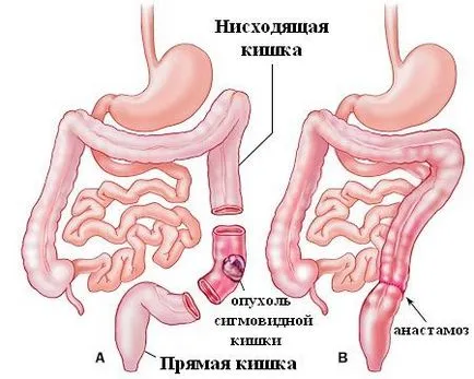 Сигмовиднакишка симптоми захворювань та їх лікування (пухлин сигмовидної кишки) Сигмовиднакишка симптоми захворювань та їх лікування