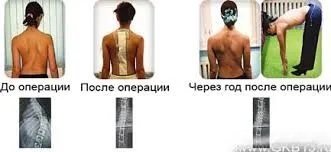 Сколіоз хребта у підлітків діагностика, методи лікування (хребта) Сколіоз хребта у підлітків діагностика, методи лікування