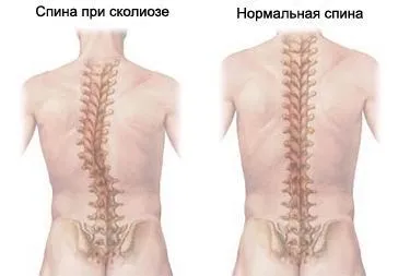 Сколіоз фото ступенів і опис проявів (Головна особливість кут) Сколіоз фото ступенів і опис проявів