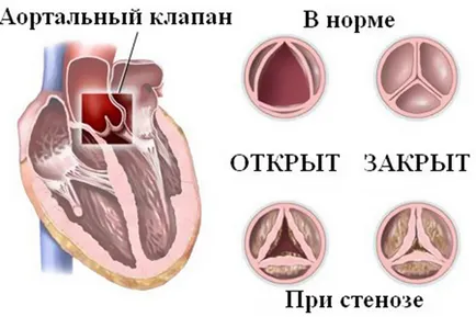 Стеноз аортального клапана симптоми, лікування (аортального) Стеноз аортального клапана симптоми, лікування
