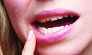 Стоматит при вагітності як і чим лікувати (вагітності) Стоматит при вагітності як і чим лікувати