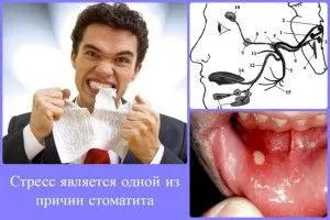 Стоматит при вагітності як і чим лікувати (лікування іншому випадку) Стоматит при вагітності як і чим лікувати