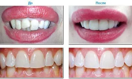 Вартість вирівнювання зубів винирами, лікування зубів (зубів) Вартість вирівнювання зубів винирами, лікування зубів