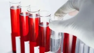 Фіброма яєчника характеристика та причини виникнення, ознаки та методи лікування новоутворення (фіброма) Фіброма яєчника характеристика та причини виникнення, ознаки та методи лікування новоутворення