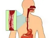 Звуження стравоходу види, симптоми і лікування стриктури (лікування) Звуження стравоходу види, симптоми і лікування стриктури