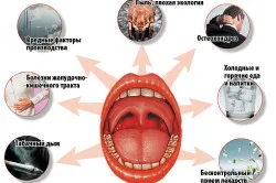 Субатрофіческій фарингіт симптоми і лікування (субатрофический) Субатрофіческій фарингіт симптоми і лікування