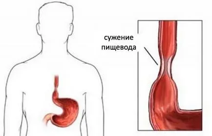 Звуження стравоходу види, симптоми і лікування стриктури (звуження стравоходу стриктура причини класифікація форми симптоми діагностика лікування профілактика) Звуження стравоходу види, симптоми і лікування стриктури