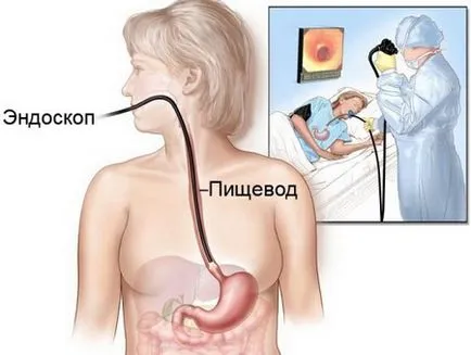 Звуження стравоходу види, симптоми і лікування стриктури (стравоходу) Звуження стравоходу види, симптоми і лікування стриктури