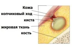 Свищ на п'ятій точці причини, симптоми, лікування і ускладнення - секрети здоров'я (свищ) Свищ на п'ятій точці причини, симптоми, лікування і ускладнення - секрети здоров'я
