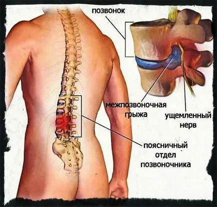Травми спини при становій тязі що робити при болях в попереку (причини, симптоми і лікування) (спини) Травми спини при становій тязі що робити при болях в попереку (причини, симптоми і лікування)