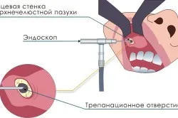 Видалення кісти гайморової пазухи (про кісту) Видалення кісти гайморової пазухи