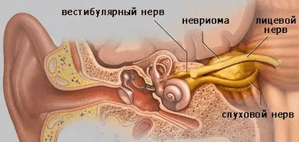 видалення невриноми