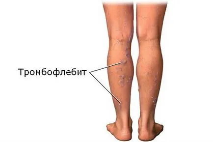 Тяжкість в ногах причини, симптоми і лікування при проблемі (ногах) Тяжкість в ногах причини, симптоми і лікування при проблемі