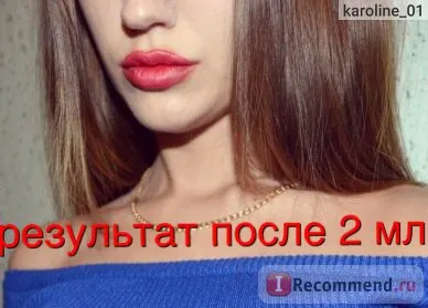 Збільшення губ за допомогою препарату гіалуронової кислоти - «оновлення грудень 2016 фото після 4-ої (після) Збільшення губ за допомогою препарату гіалуронової кислоти - «оновлення грудень 2016 фото після 4-ої