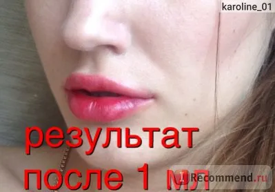 Збільшення губ за допомогою препарату гіалуронової кислоти - «оновлення грудень 2016 фото після 4-ої (після) Збільшення губ за допомогою препарату гіалуронової кислоти - «оновлення грудня 2016 фото після 4-ої