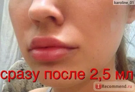 Збільшення губ за допомогою препарату гіалуронової кислоти - «оновлення грудень 2016 фото після 4-ої (препарату) Збільшення губ за допомогою препарату гіалуронової кислоти - «оновлення грудень 2016 фото після 4-ої