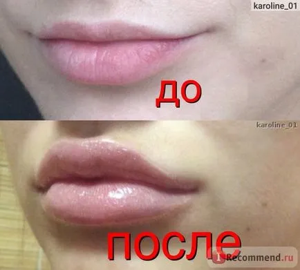 Збільшення губ за допомогою препарату гіалуронової кислоти - «оновлення грудень 2016 фото після 4-ої (препарату) Збільшення губ за допомогою препарату гіалуронової кислоти - «оновлення грудень 2016 фото після 4-ої