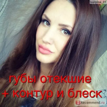 Збільшення губ за допомогою препарату гіалуронової кислоти - «оновлення грудень 2016 фото після 4-ої (препарату) Збільшення губ за допомогою препарату гіалуронової кислоти - «оновлення грудень 2016 фото після 4-ої