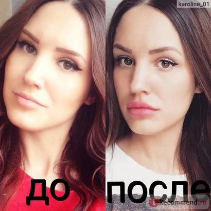 Збільшення губ за допомогою препарату гіалуронової кислоти - «оновлення грудень 2016 фото після 4-ої (після) Збільшення губ за допомогою препарату гіалуронової кислоти - «оновлення грудень 2016 фото після 4-ої