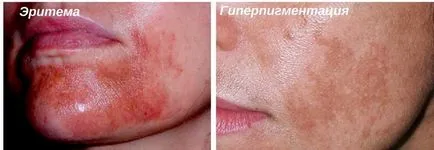 Догляд після пілінгу ТСА як доглядати за шкірою обличчя по днях, на що звернути увагу після середнього (ТСА пілінг догляд після пілінгу по днях) Догляд після пілінгу ТСА як доглядати за шкірою обличчя по днях, на що звернути увагу після середнього