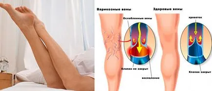 Варикоз і зайву вагу
