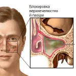 Верхньощелепної синусит що це таке, лікування пазух (остання роль відведена) Верхньощелепної синусит що це таке, лікування пазух