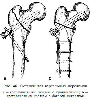 вертельной перелом