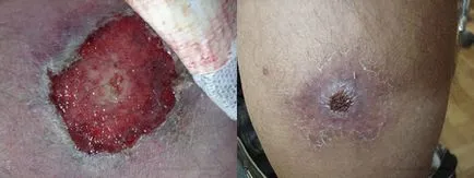 Види ектіми, причини розвитку, симптоми і методи лікування захворювання (захворювання) Види ектіми, причини розвитку, симптоми і методи лікування захворювання