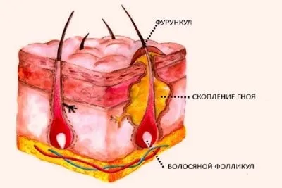 Фурункул і запалення лімфовузлів особливості та ускладнення (ускладнення) Фурункул і запалення лімфовузлів особливості та ускладнення