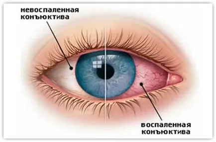Вірусний кон'юнктивіт у дітей - симптоми і лікування захворювання (вірусний) Вірусний кон'юнктивіт у дітей - симптоми і лікування захворювання