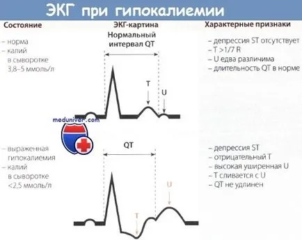Вплив калію на ЕКГ