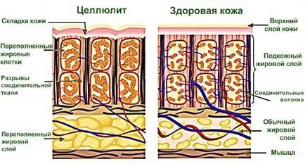 Все, що ви хотіли знати про целюліт, але боялися запитати