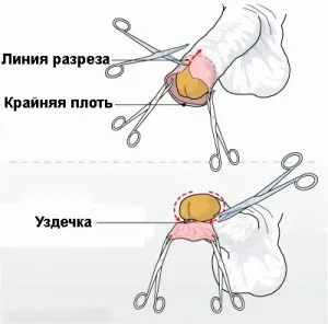 Хірургічне лікування фімозу (носить назву фімозу) Хірургічне лікування фімозу