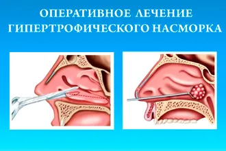 Хронічний гіпертрофічний риніт - операція і лікування народними засобами
