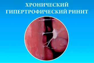 Хронічний гіпертрофічний риніт - операція і лікування народними засобами