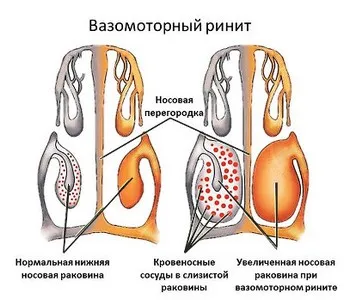Задній риніт у дітей лікування, симптоми і причини (задній) Задній риніт у дітей лікування, симптоми і причини