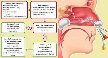 Задній риніт - причини, ознаки, симптоми і лікування (лікування) Задній риніт - причини, ознаки, симптоми і лікування