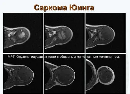 Злоякісна пухлина у дитини види пухлин і їх лікування (дитини) Злоякісна пухлина у дитини види пухлин і їх лікування