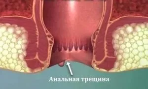 геморой кровит