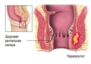 геморой кровит